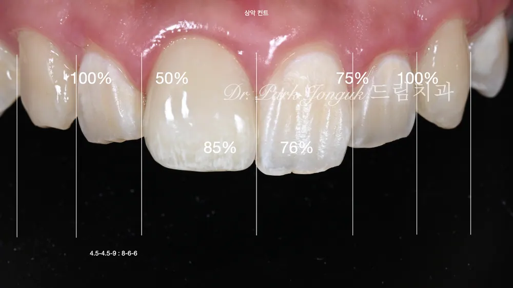การรักษาซ้ำครอบฟันเซรามิกล้วนและวีเนียร์ฟันหน้า — ภาพที่ 2