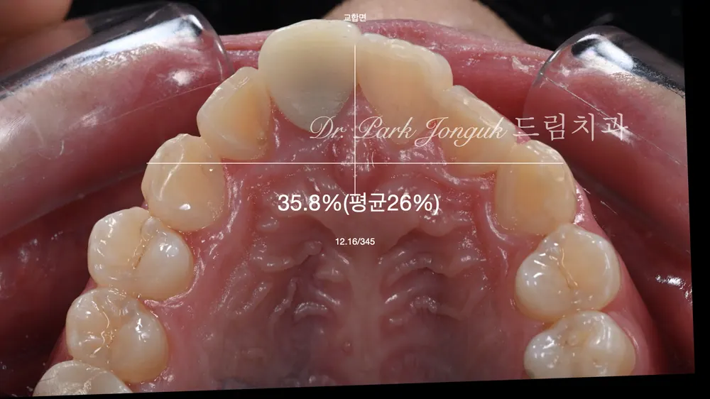 การรักษาซ้ำครอบฟันเซรามิกล้วนและวีเนียร์ฟันหน้า — ภาพที่ 4