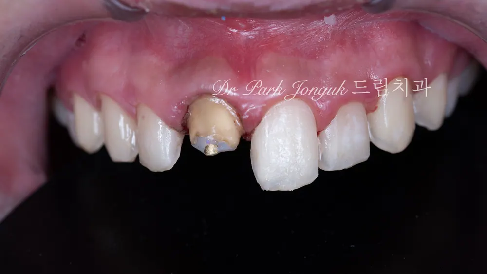 การรักษาซ้ำครอบฟันเซรามิกล้วนและวีเนียร์ฟันหน้า — ภาพที่ 7