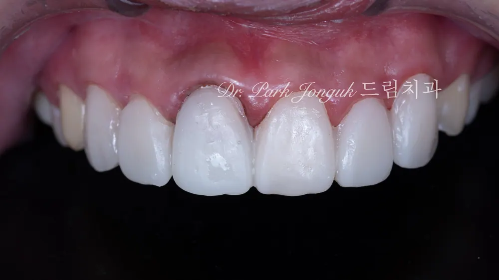 การรักษาซ้ำครอบฟันเซรามิกล้วนและวีเนียร์ฟันหน้า — ภาพที่ 8