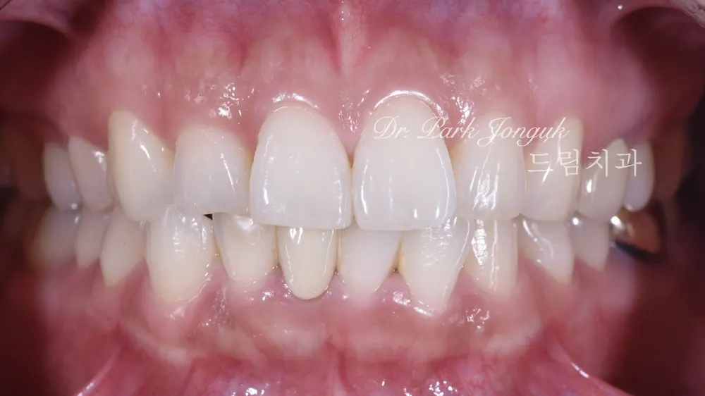 Nha khoa Cheongdam — Điều trị dán sứ Veneer cho răng cửa hô nổi bật — ảnh 1
