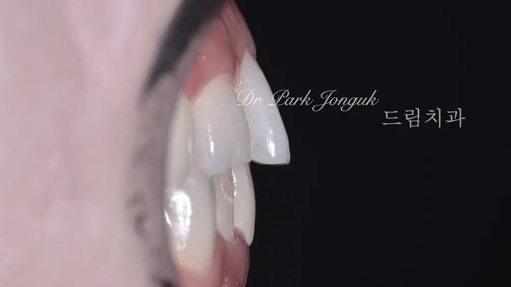 Nha khoa Cheongdam — Điều trị dán sứ Veneer cho răng cửa hô nổi bật — ảnh 2