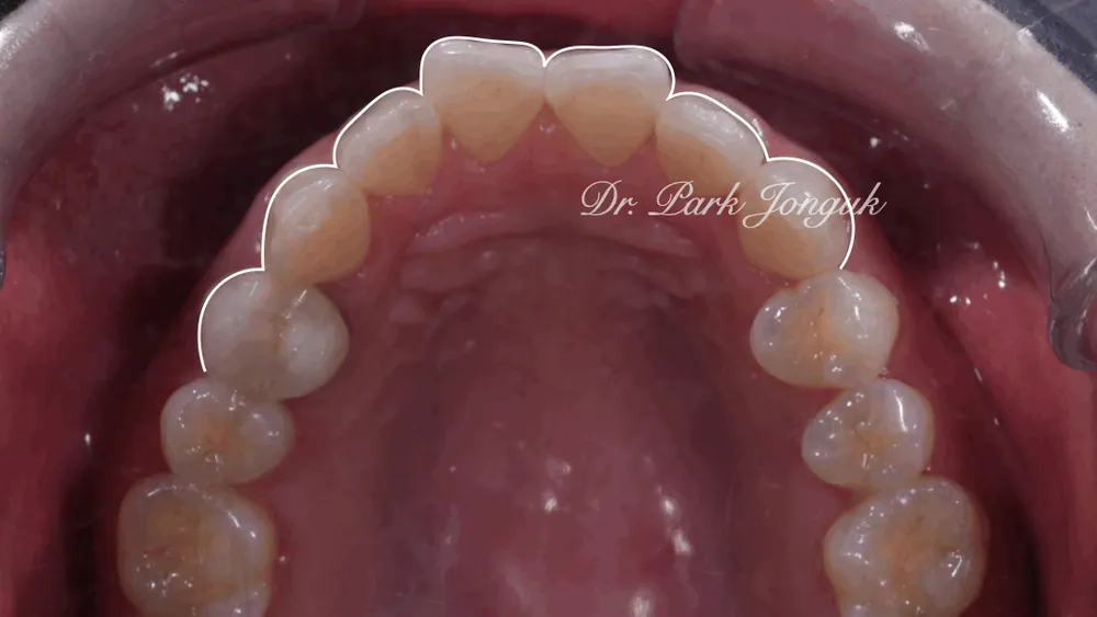 Nha khoa Cheongdam — Điều trị dán sứ Veneer cho răng cửa hô nổi bật — ảnh 3