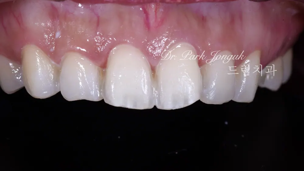 Nha khoa Cheongdam — Điều trị dán sứ Veneer cho răng cửa hô nổi bật — ảnh 5