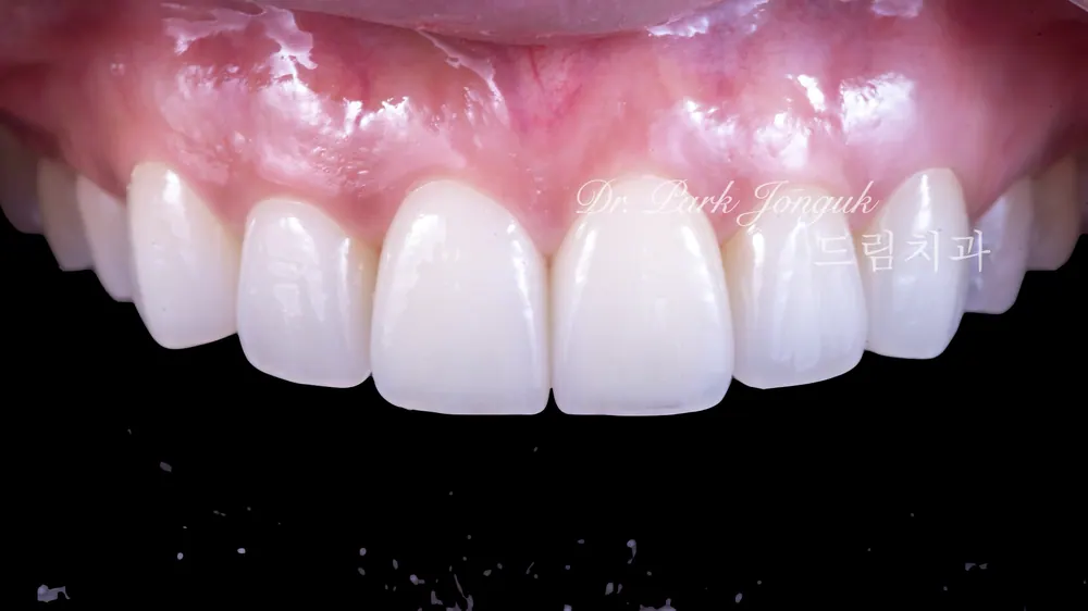 Nha khoa Cheongdam — Điều trị dán sứ Veneer cho răng cửa hô nổi bật — ảnh 6