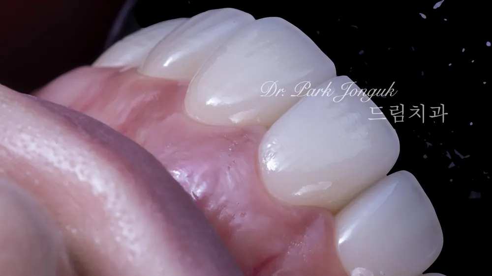 Nha khoa Cheongdam — Điều trị dán sứ Veneer cho răng cửa hô nổi bật — ảnh 8