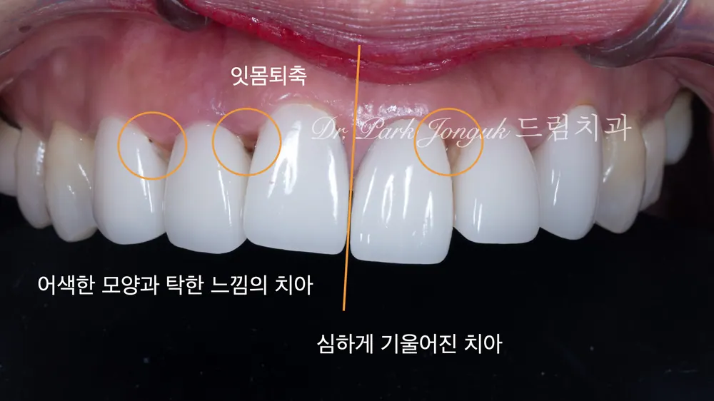어색한 앞니 라미네이트를 자연스럽게 재시술 본문 사진 2