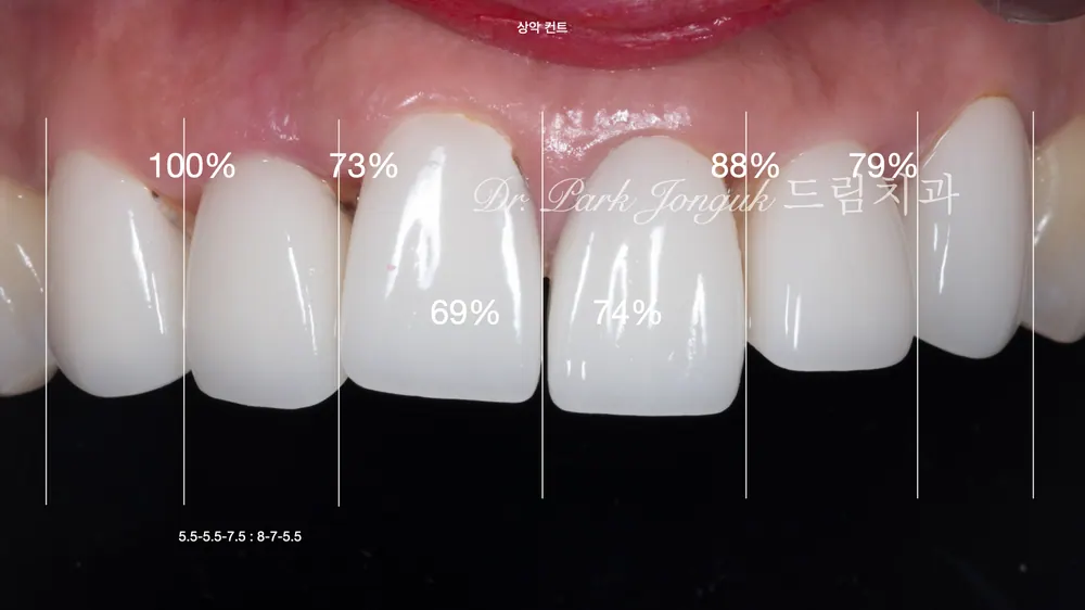 어색한 앞니 라미네이트를 자연스럽게 재시술 본문 사진 3
