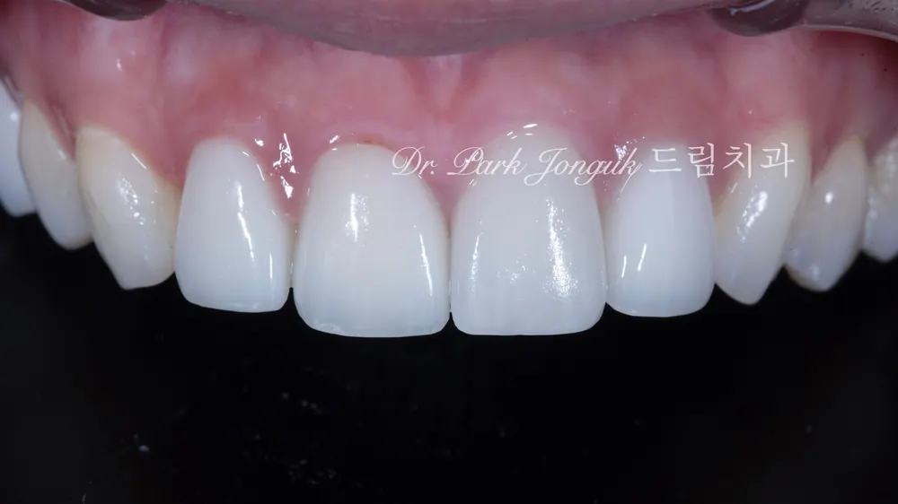 When Veneer Side Effects Call for Retreatment — photo 1