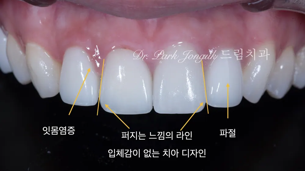 When Veneer Side Effects Call for Retreatment — photo 2
