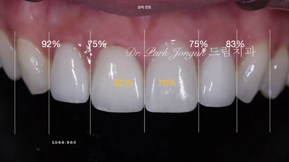 When Veneer Side Effects Call for Retreatment — photo 3