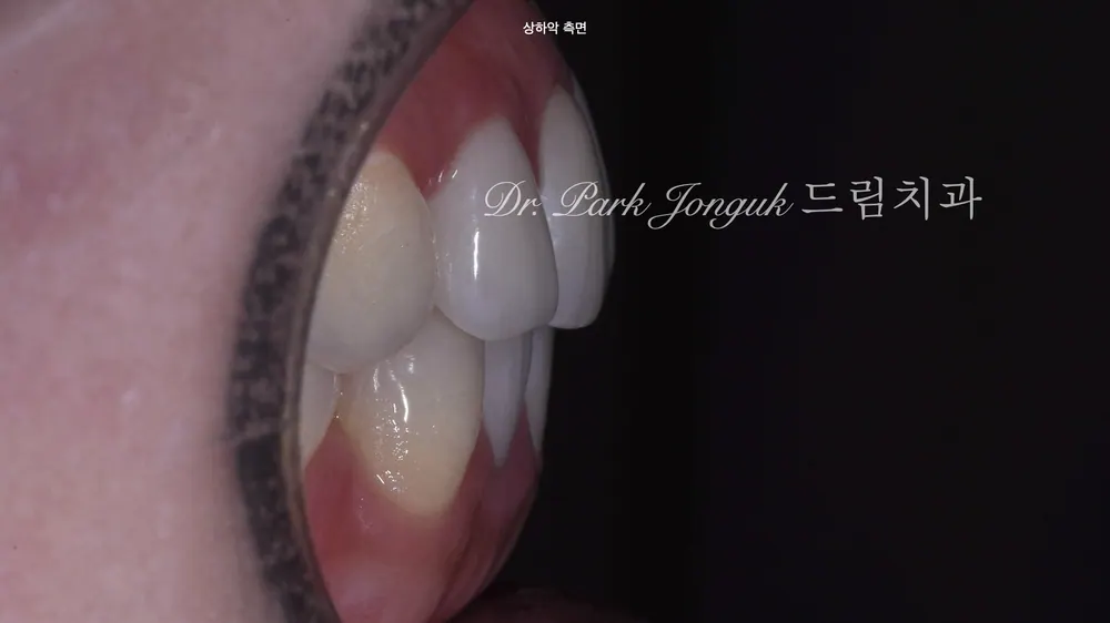 When Veneer Side Effects Call for Retreatment — photo 4