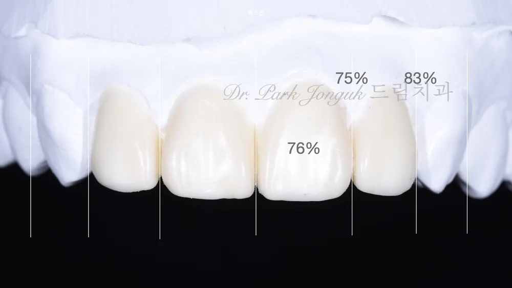 When Veneer Side Effects Call for Retreatment — photo 6