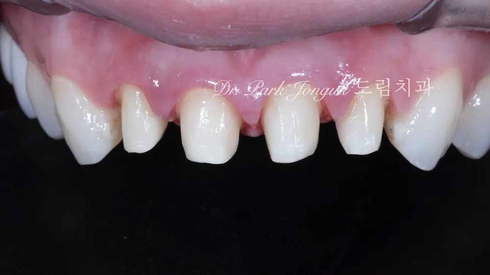 When Veneer Side Effects Call for Retreatment — photo 7