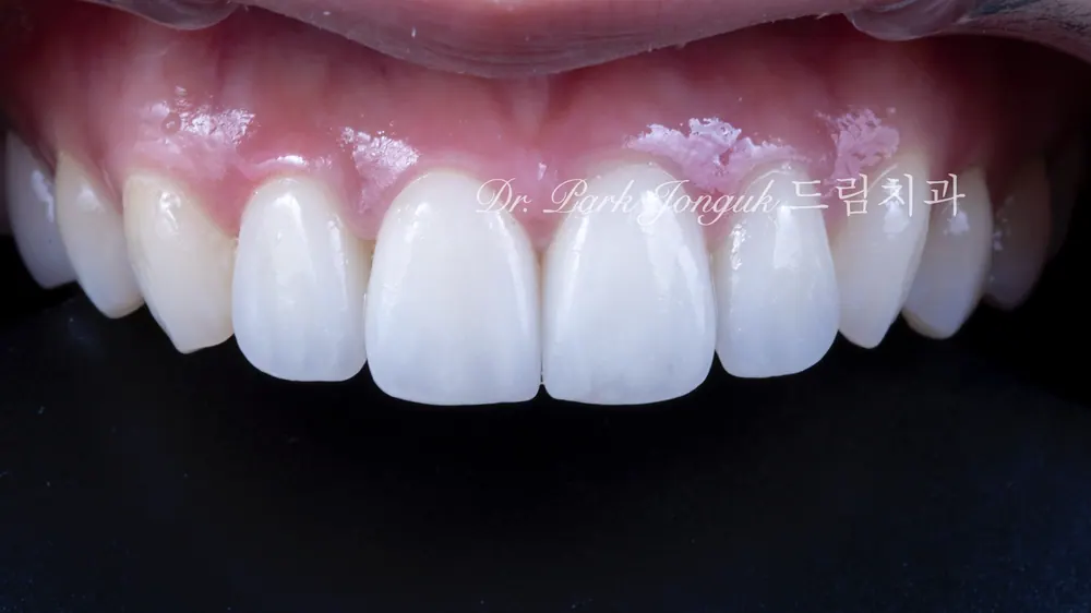 When Veneer Side Effects Call for Retreatment — photo 8