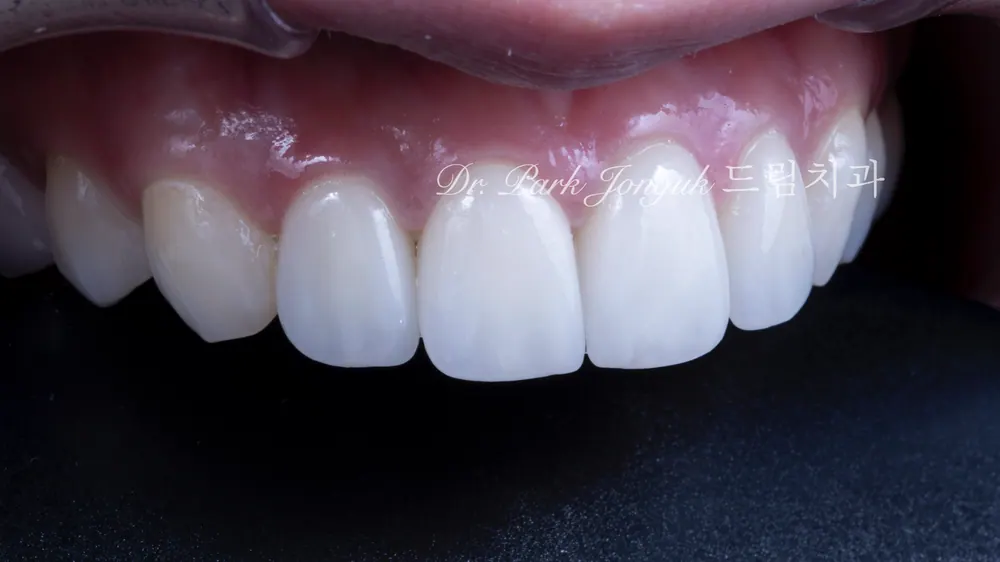 When Veneer Side Effects Call for Retreatment — photo 9