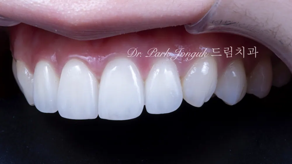 When Veneer Side Effects Call for Retreatment — photo 10