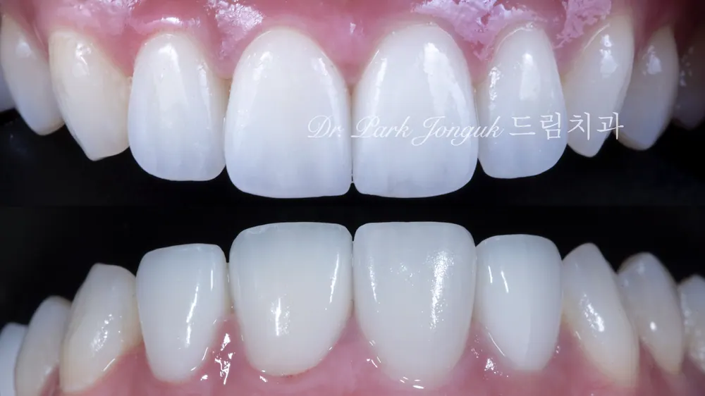 When Veneer Side Effects Call for Retreatment — photo 11