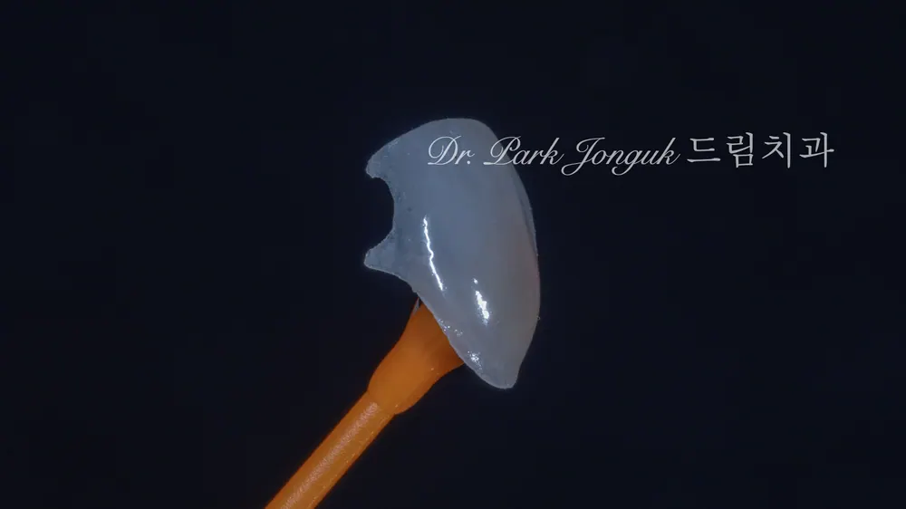 블랙트라이앵글의 무삭제 라미네이트 치료 본문 사진 2