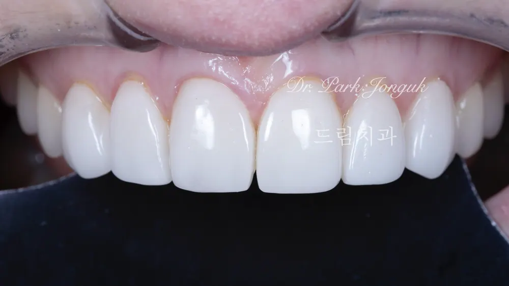 Làm lại Veneer thiếu tự nhiên và gượng gạo — ảnh 1