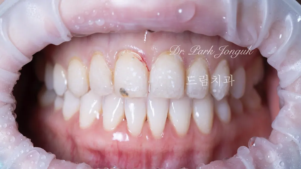 Làm lại Veneer thiếu tự nhiên và gượng gạo — ảnh 2
