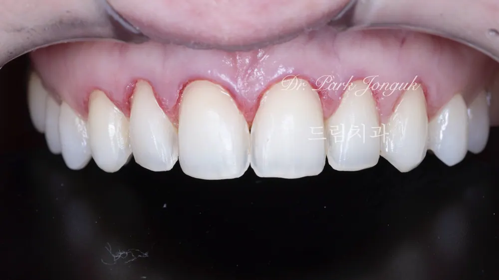 Làm lại Veneer thiếu tự nhiên và gượng gạo — ảnh 3
