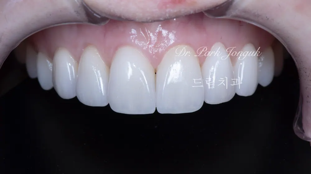 Làm lại Veneer thiếu tự nhiên và gượng gạo — ảnh 4