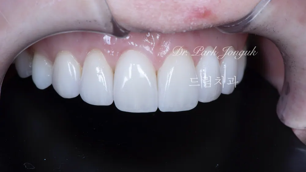 Làm lại Veneer thiếu tự nhiên và gượng gạo — ảnh 5