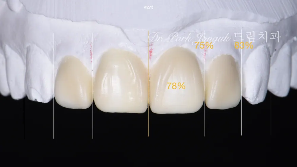 การรักษาซ้ำครอบฟันเซรามิกล้วนและวีเนียร์ฟันหน้า คลินิกทันตกรรมดรีม ย่านซินซาดง — ภาพที่ 4