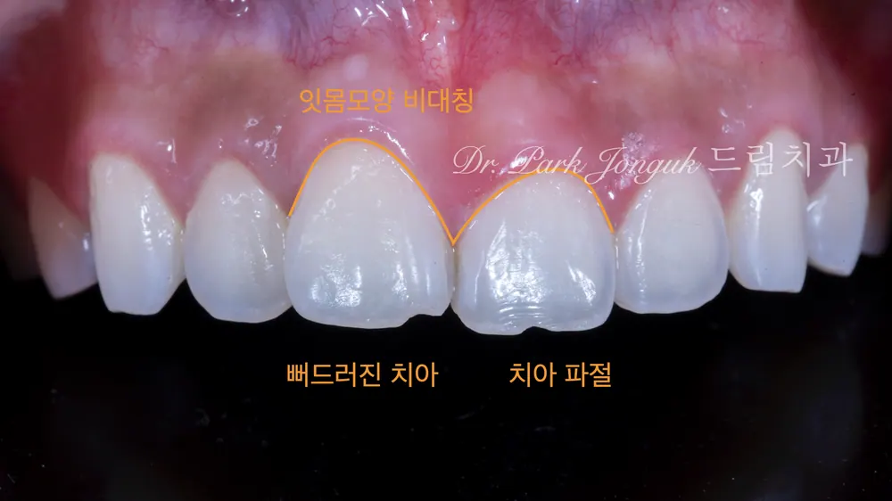 무삭제 라미네이트와 삭제하는 라미네이트의 조화 본문 사진 2