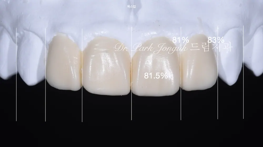 디테일을 살리는 라미네이트, 올세라믹 크라운 재시술 본문 사진 4