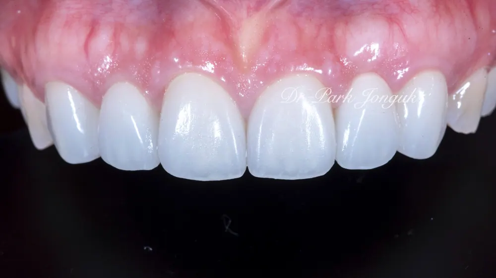 瓷贴面重做：呈现自然牙齿效果 — 图2