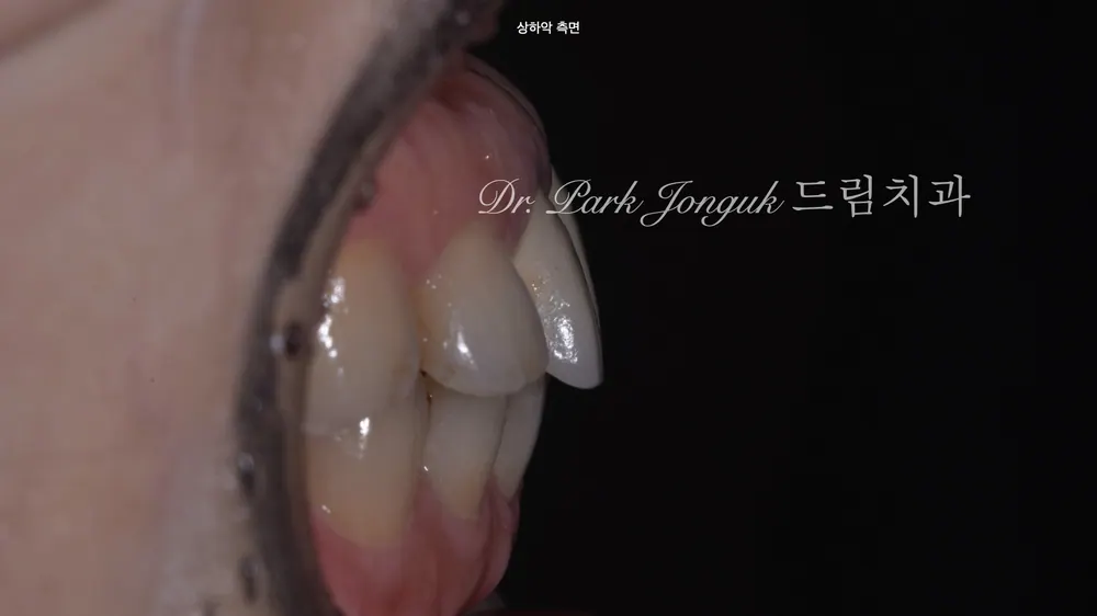 신경치료로 잇몸이 검게 변한 오래된 올세라믹 크라운의 재시술 본문 사진 3