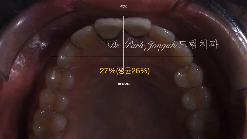 신경치료로 잇몸이 검게 변한 오래된 올세라믹 크라운의 재시술 본문 사진 4