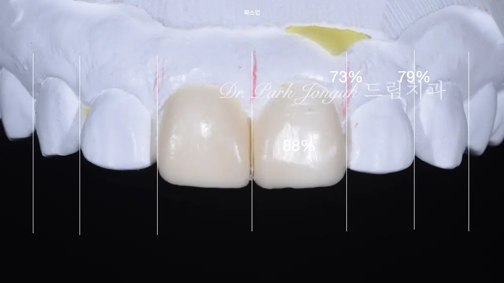 신경치료로 잇몸이 검게 변한 오래된 올세라믹 크라운의 재시술 본문 사진 5