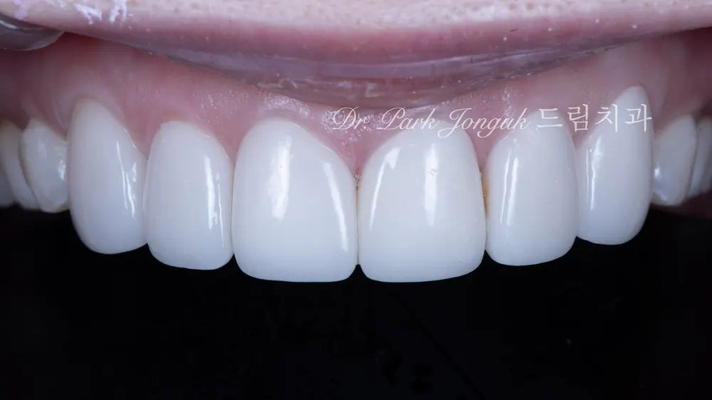 Làm lại tự nhiên cho Veneer gượng gạo, thiếu tự nhiên — ảnh 1