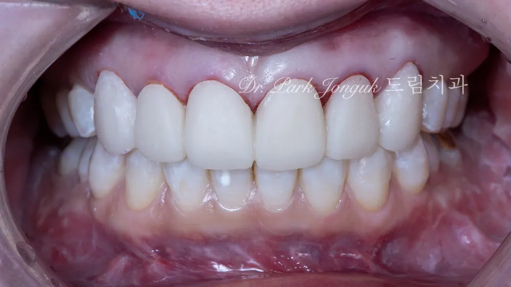 Làm lại tự nhiên cho Veneer gượng gạo, thiếu tự nhiên — ảnh 3