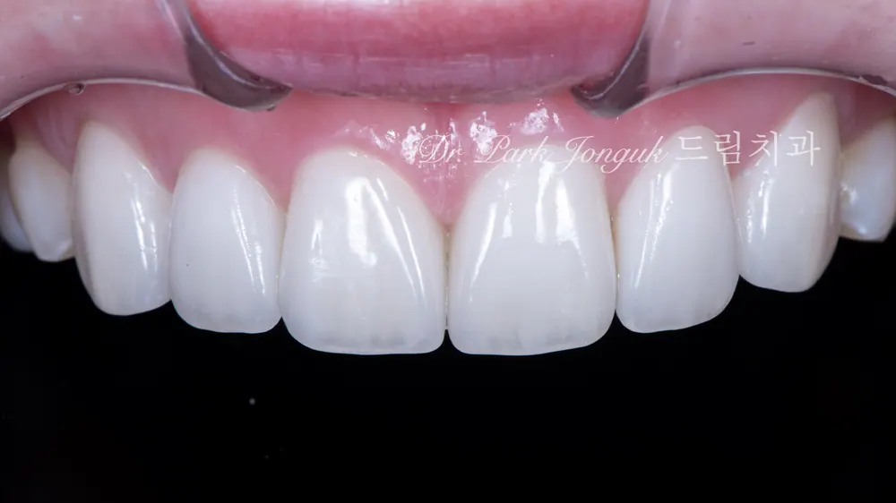 Làm lại tự nhiên cho Veneer gượng gạo, thiếu tự nhiên — ảnh 4