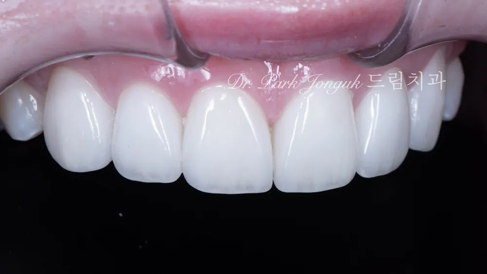 Làm lại tự nhiên cho Veneer gượng gạo, thiếu tự nhiên — ảnh 5