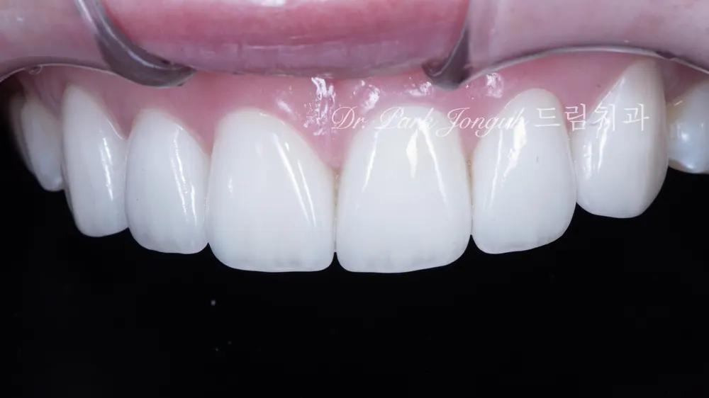 Làm lại tự nhiên cho Veneer gượng gạo, thiếu tự nhiên — ảnh 6