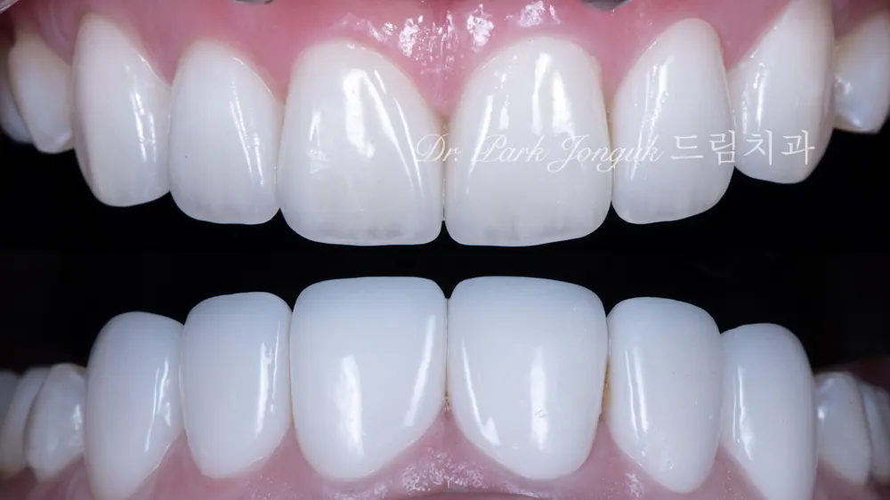 Làm lại tự nhiên cho Veneer gượng gạo, thiếu tự nhiên — ảnh 7