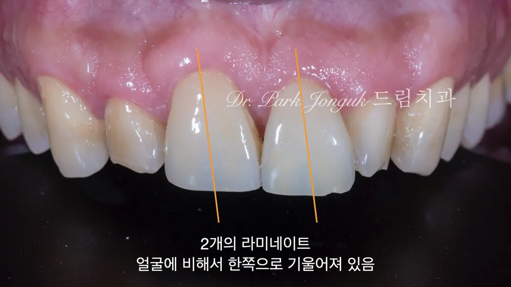 무삭제 라미네이트와 라미네이트 재시술 본문 사진 2