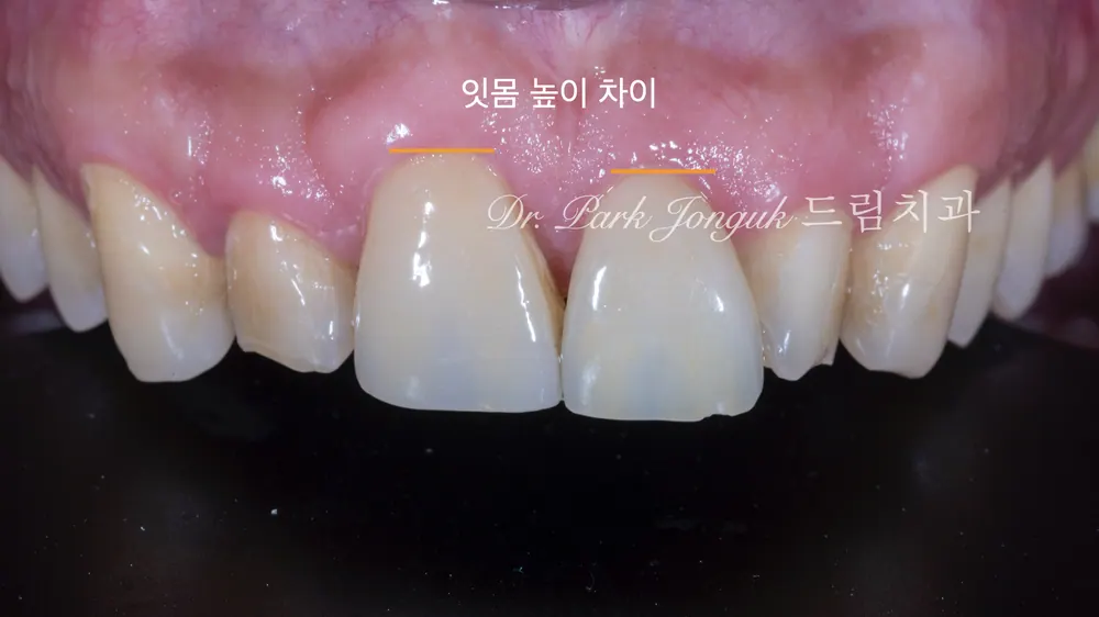 무삭제 라미네이트와 라미네이트 재시술 본문 사진 3