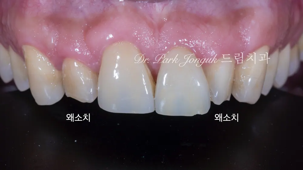 무삭제 라미네이트와 라미네이트 재시술 본문 사진 4