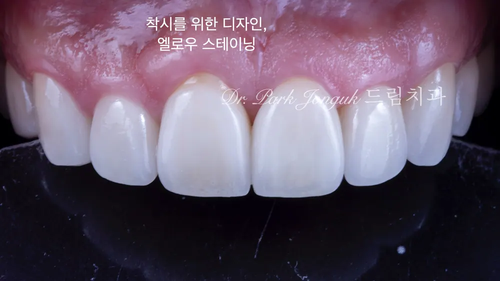 무삭제 라미네이트와 라미네이트 재시술 본문 사진 5