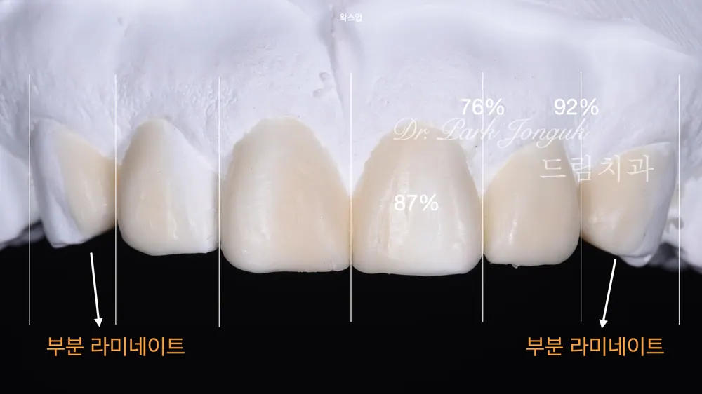 削らないラミネートベニア、施術からケアまで — 写真5