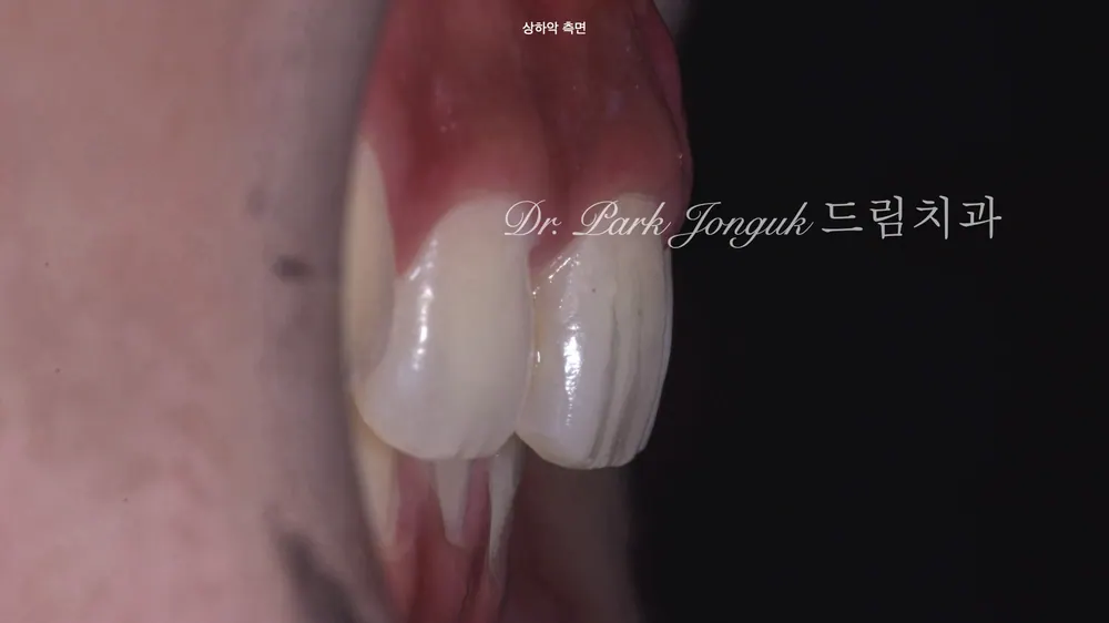 치아 교정 후 옥니의 무삭제 라미네이트 본문 사진 3