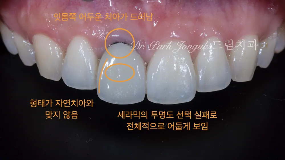잇몸이 검게 변한 올세라믹 크라운의 재시술 본문 사진 2