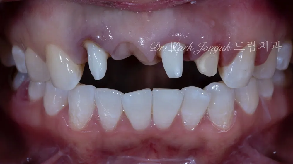 การรักษาซ้ำครอบฟันเซรามิกล้วนและสะพานฟันหน้าที่มีการอักเสบ คลินิกทันตกรรมอัพกูจอง — ภาพที่ 6
