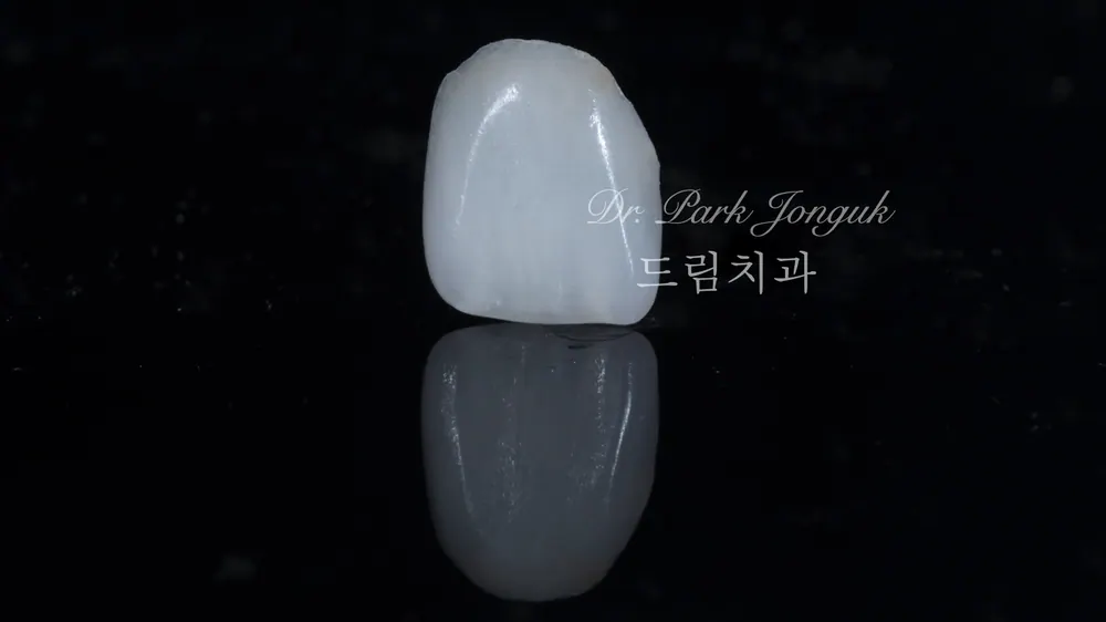 강남라미네이트치과 잇몸성형을 동반할 때 본문 사진 3